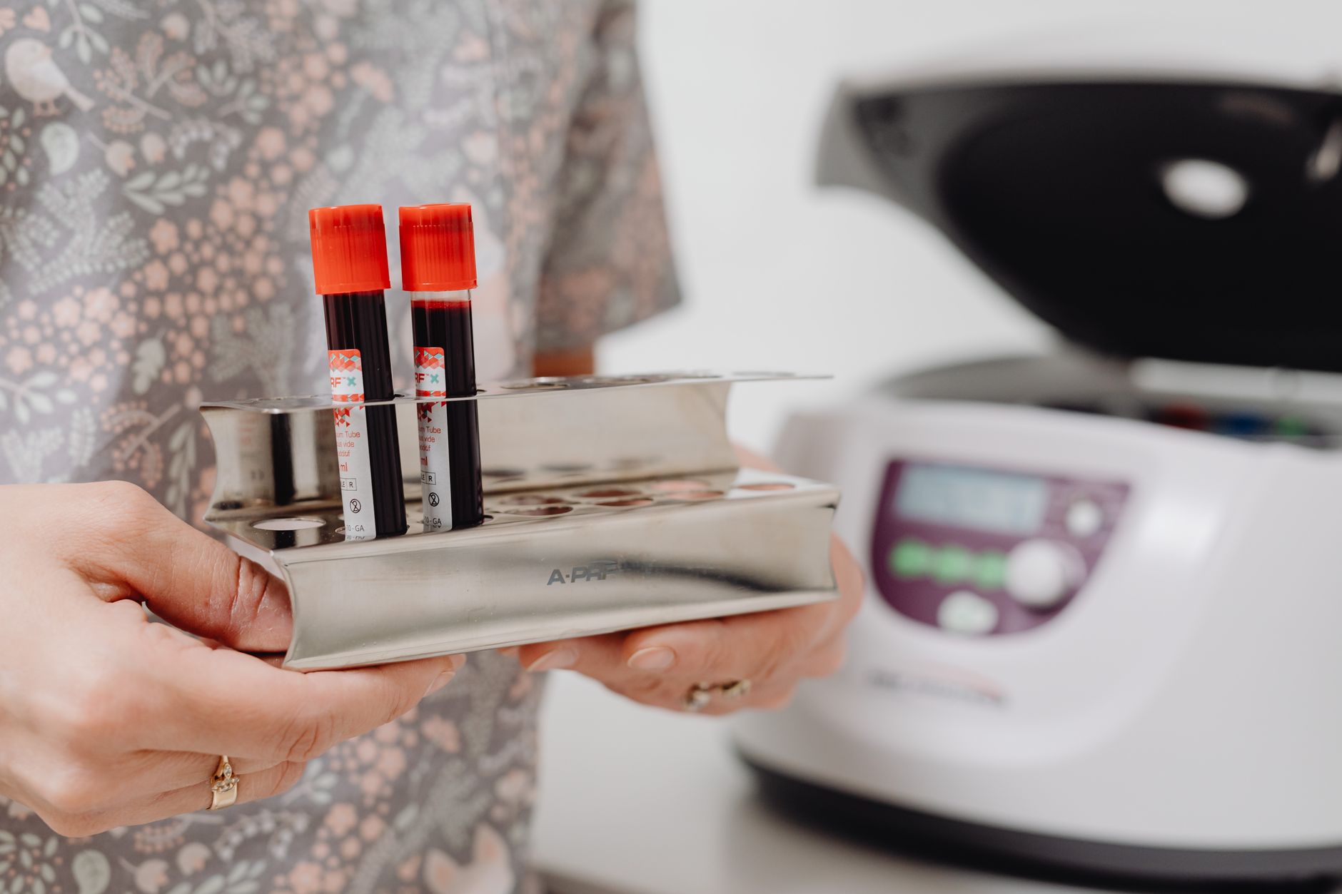 Interpretarea rezultatelor HbA1c: cum indică hemoglobina glicată riscul de prediabet și diabet