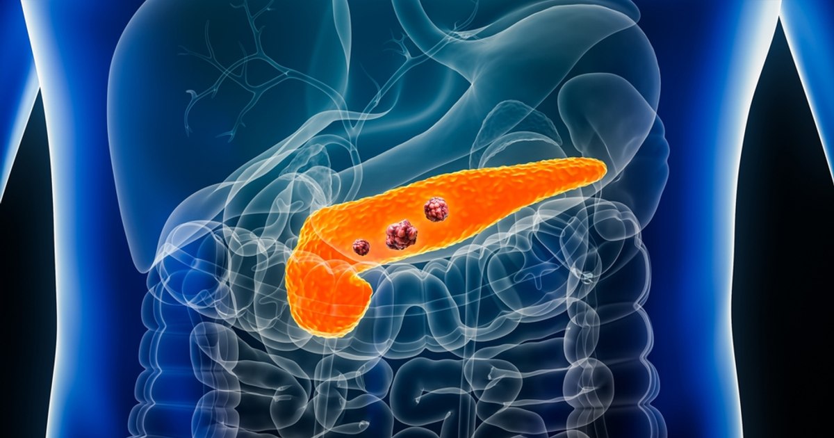 Rezultate promițătoare pentru un medicament experimental în tratamentul cancerului pancreatic metastatic