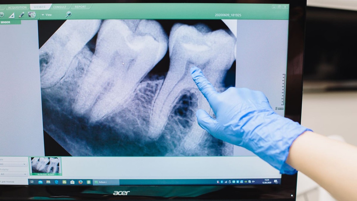 Procedura de adiție de os în implantologia dentară: necesitate, tehnici și costuri