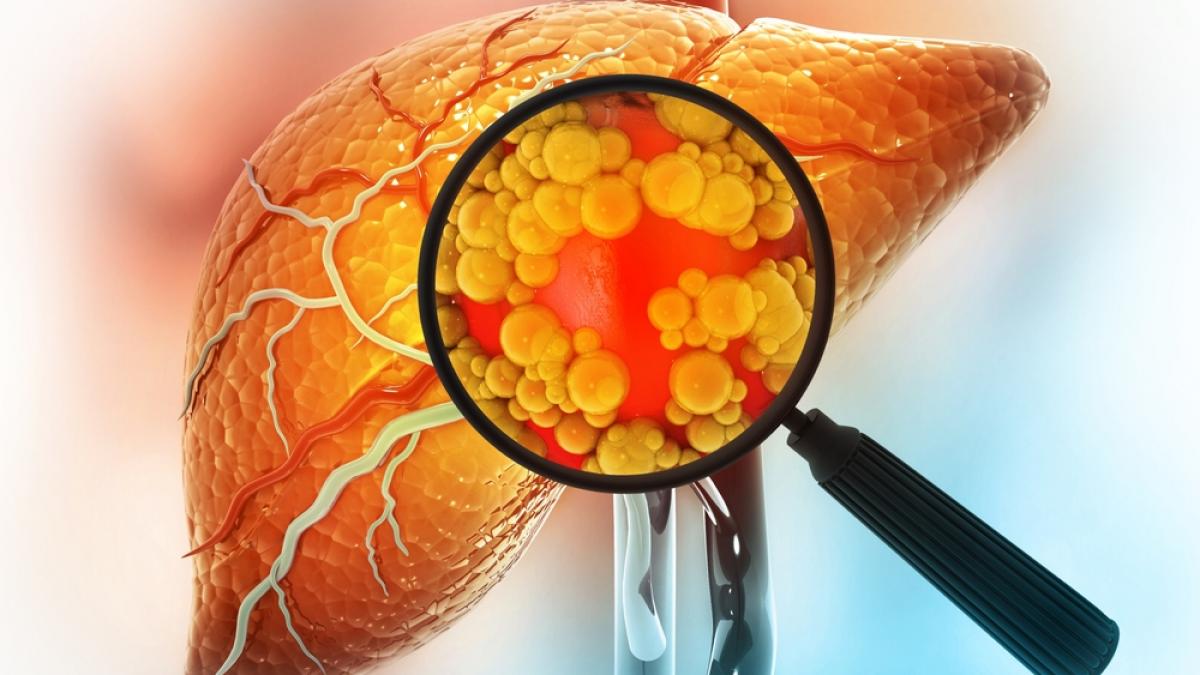 Steatoza hepatică: de la acumularea de grăsime la riscul de ciroză, cum se poate controla afecțiunea