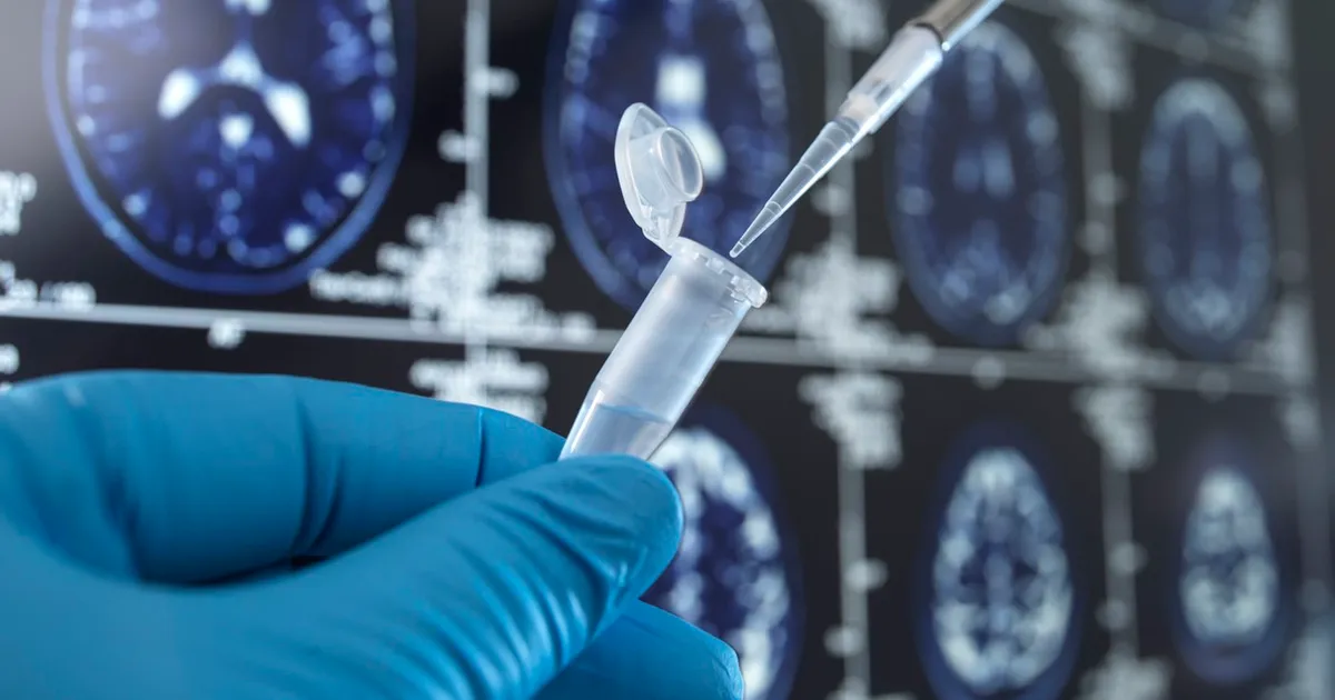 Impactul devastator al insomniei asupra sănătății cerebrale: aproape jumătate de milion de cazuri de demență pot fi evitate