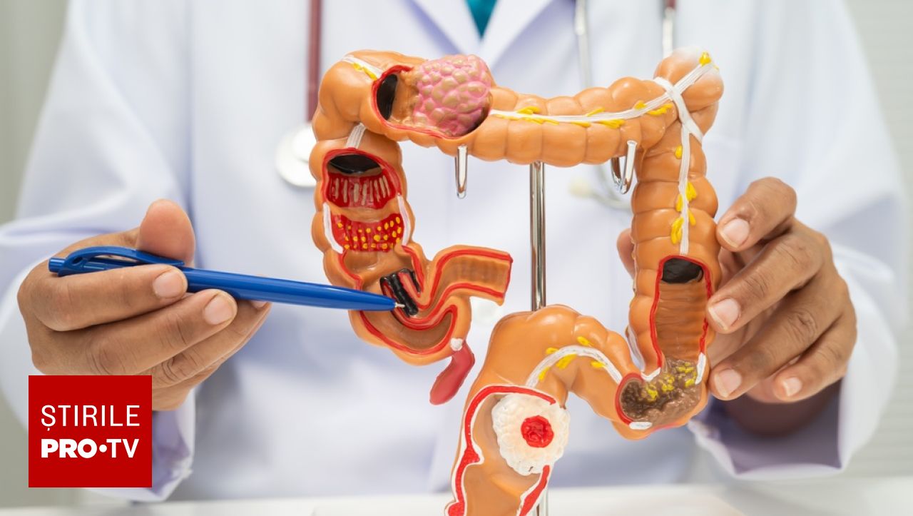 Riscul de cancer de colon este de cinci ori mai mare pentru persoanele născute după 1990