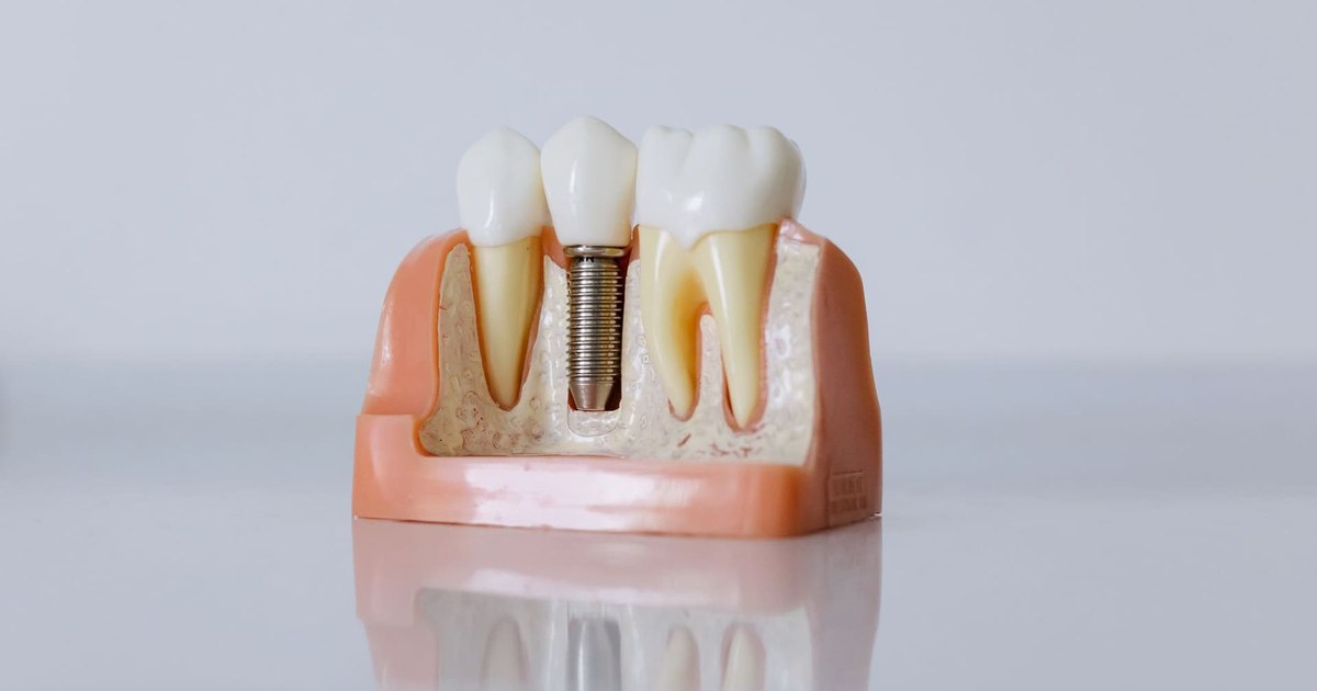 Condiții stricte pentru implanturile dentare cu încărcare imediată: nu orice pacient este eligibil