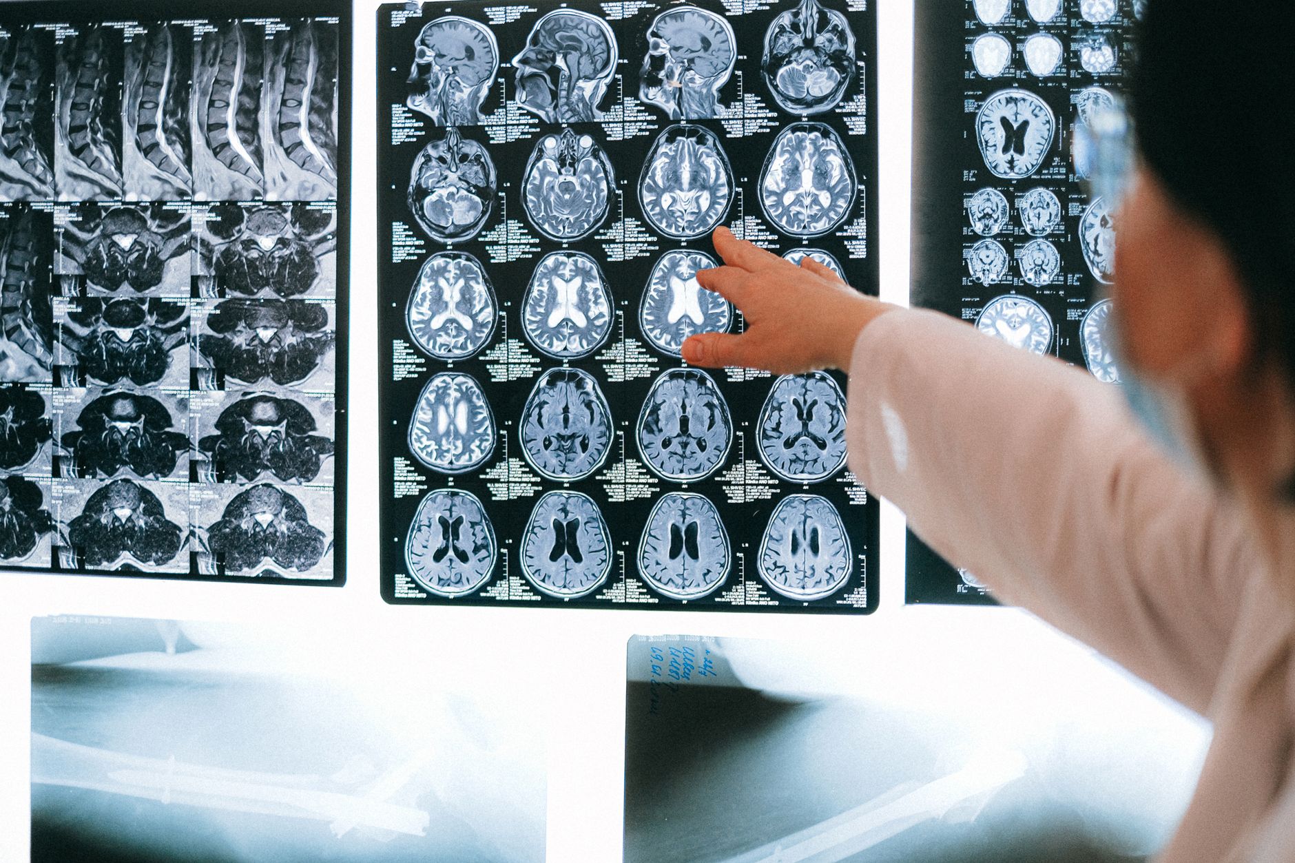Explozia accidentelor vasculare cerebrale la tineri: Incidența s-a aproape dublat în ultimele trei decenii