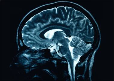 Noua descoperire medicală: Leziunile cerebrale provocate de Alzheimer ar putea fi inversate