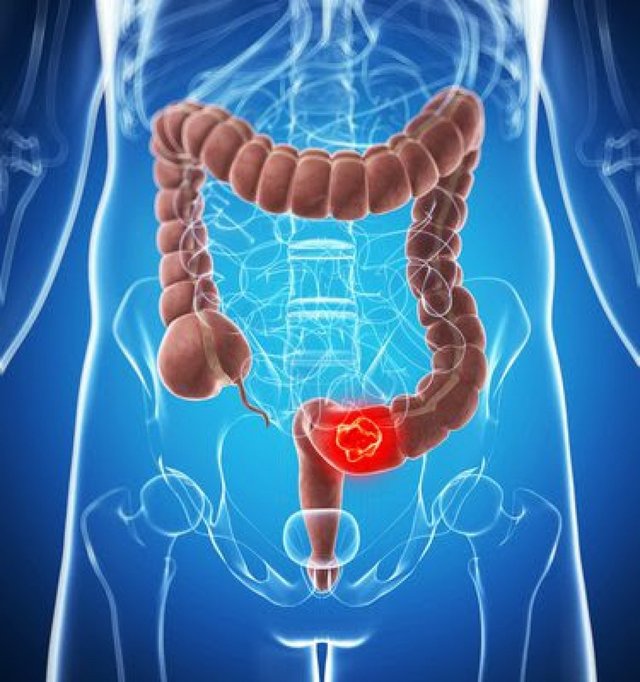 Operația pentru apendicită ar putea fi asociată cu un risc mai mic de cancer colorectal