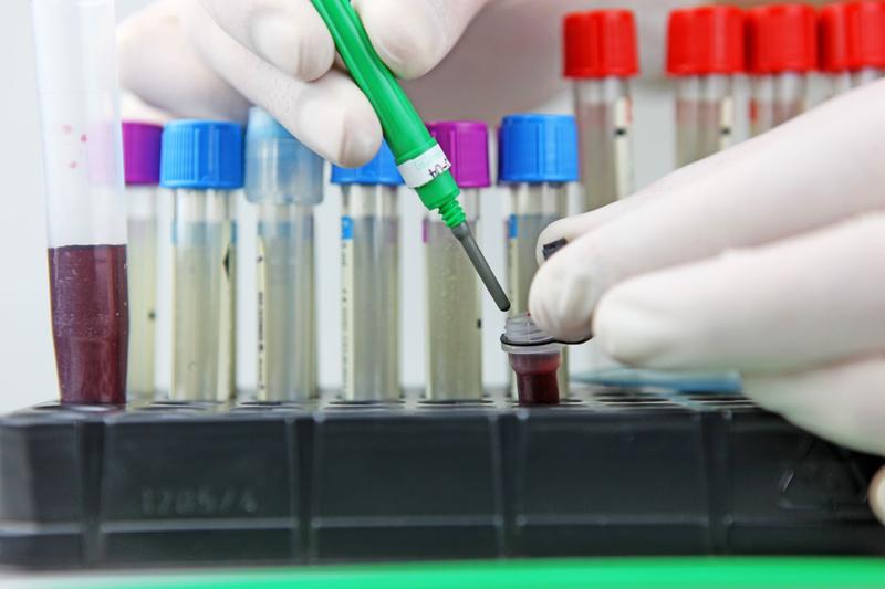 Apare o tulpină de Candidozyma auris rezistentă la patru clase de medicamente, al doilea caz la nivel mondial