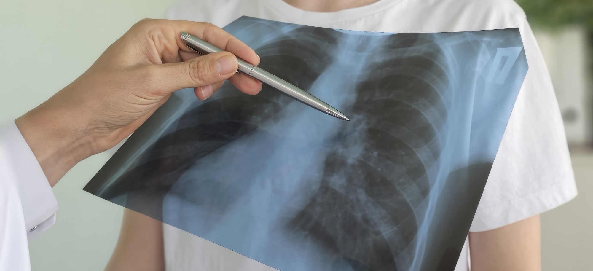 O variantă genetică rară crește de peste 60 de ori riscul de cancer pulmonar la nefumători