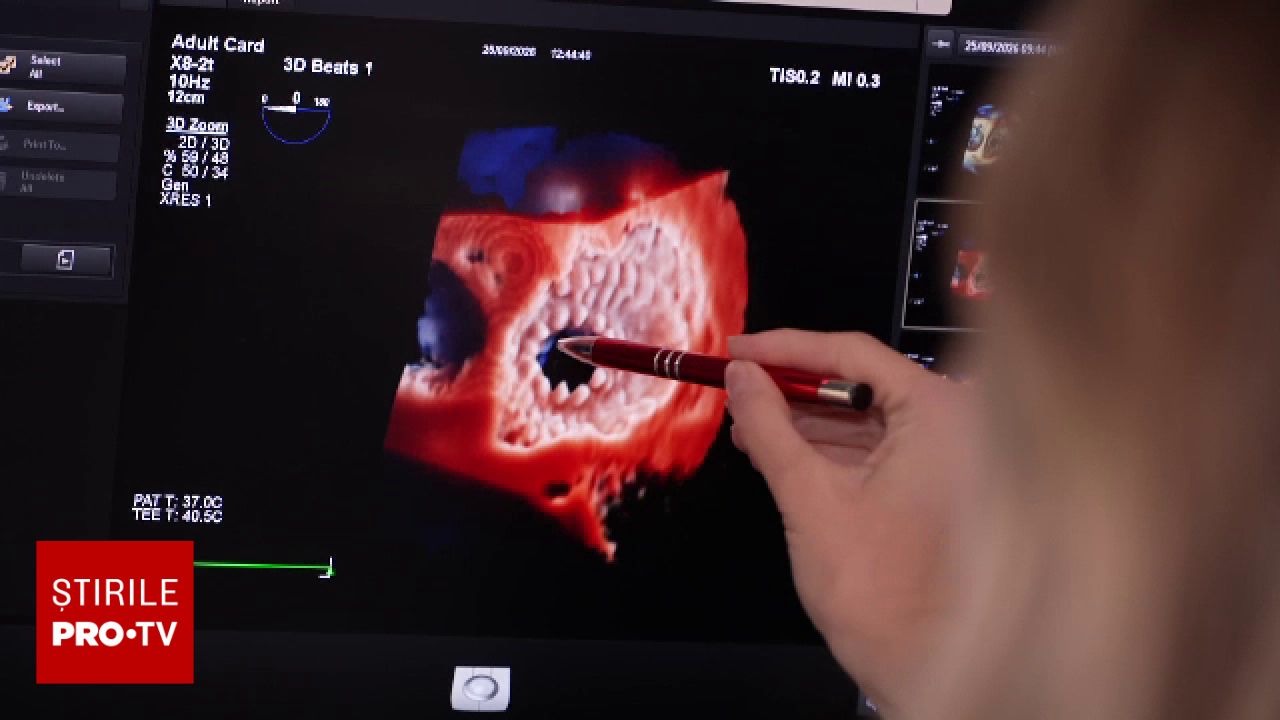 Inovație medicală la Spitalul Floreasca: implantare de valvă biologică fără oprirea inimii